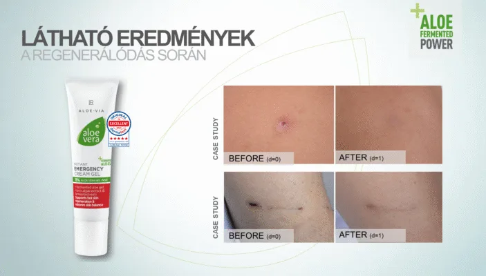 Fermentált Aloe Vera Elsősegély Gél – Gyors bőrnyugtatás Aloe Vera fermentált elsősegély gélkrém természetes nyugtató hatással