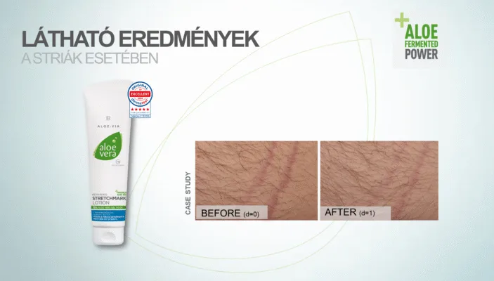 Aloe vera fermentált stria krém a bőr regenerálására és striák csökkentésére